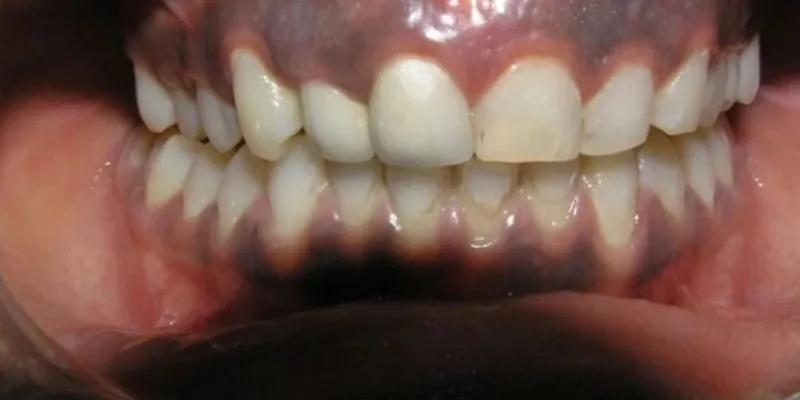 nhiễm độc chì mãn tính