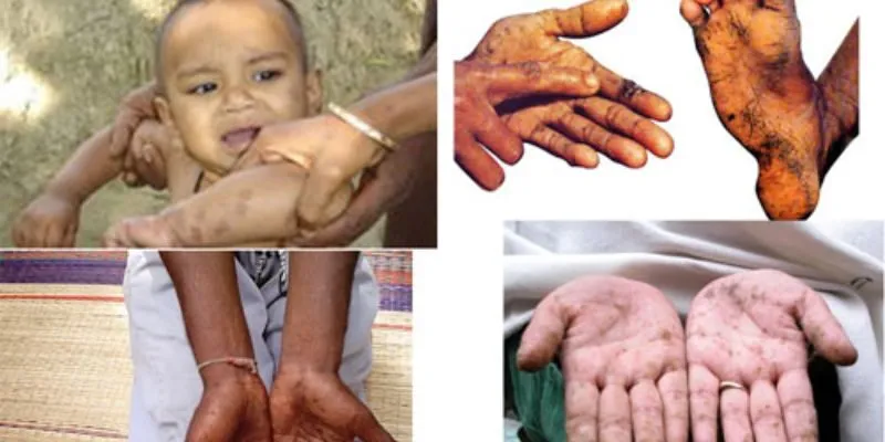 biểu hiện của nhiễm độc chì"