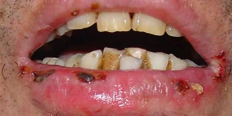 nhiễm độc chì cấp tính