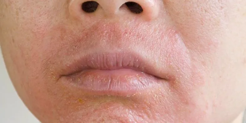 Dấu hiệu nhiễm chì