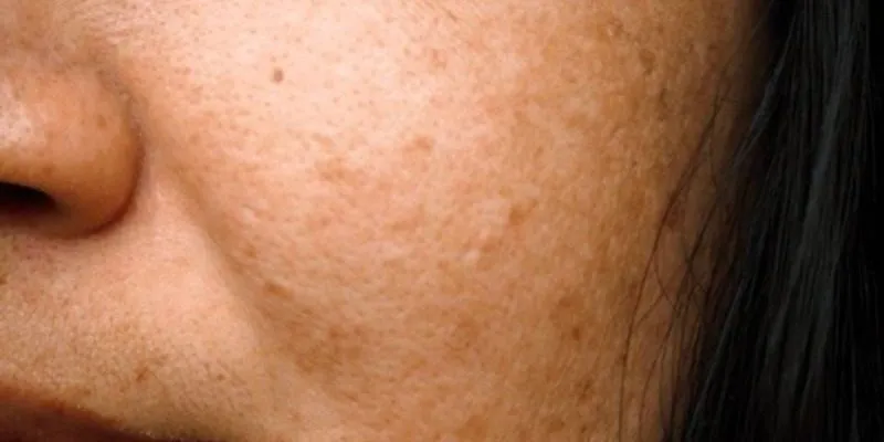 Da mặt bị nhiễm chì