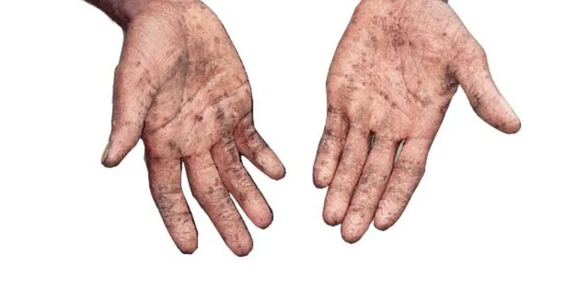 điều cần biết về nhiễm độc chì