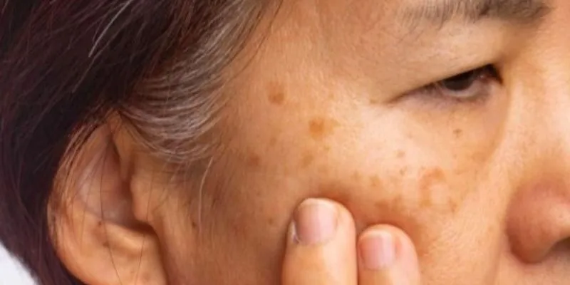 nhiễm độc chì cấp tính